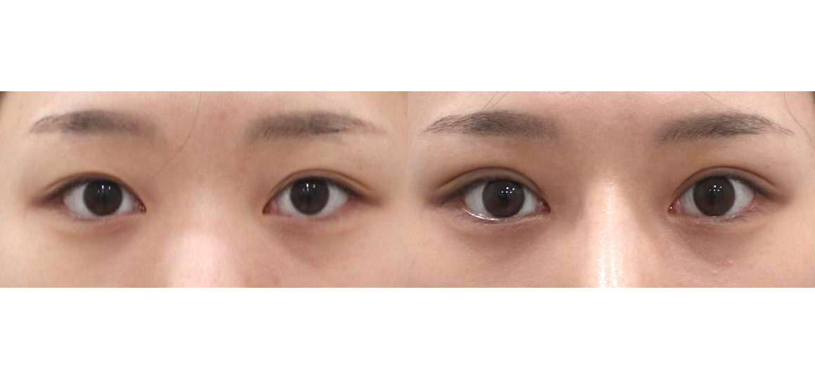 눈67